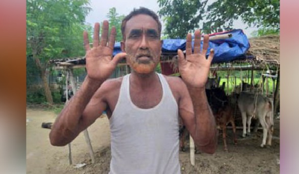 রাসেলস ভাইপারের দংশন, এক বছরেও সুস্থ হয়নি আলমের ক্ষত আঙুল - Latest BD News